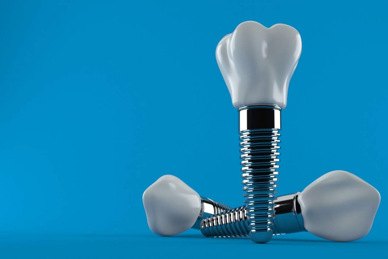 Precios de los implantes dentales en Sevilla